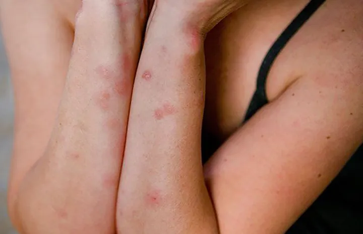 گلایه ایرانیان کانادا از وجود حشرات موذی در برخی خانه‌های اجاره‌ای